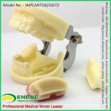 VENDER 12617 Modelo de mandíbula con implante y enchufe reemplazable